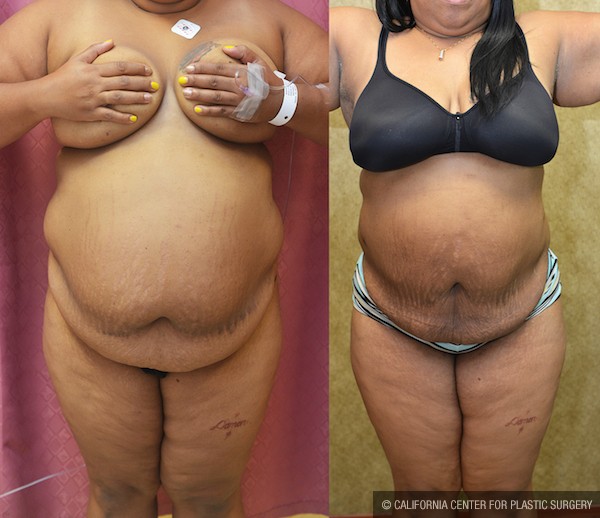 Liposuction Abdomen Plus Size Before & After Patient #12008