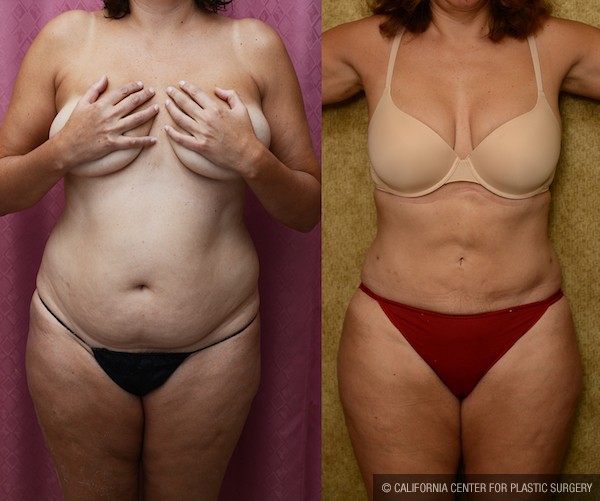 Liposuction Abdomen Medium Before & After Patient #11996
