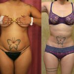 Liposuction Abdomen Medium Before & After Patient #12000