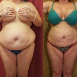 Liposuction Abdomen Plus Size Before & After Patient #12004