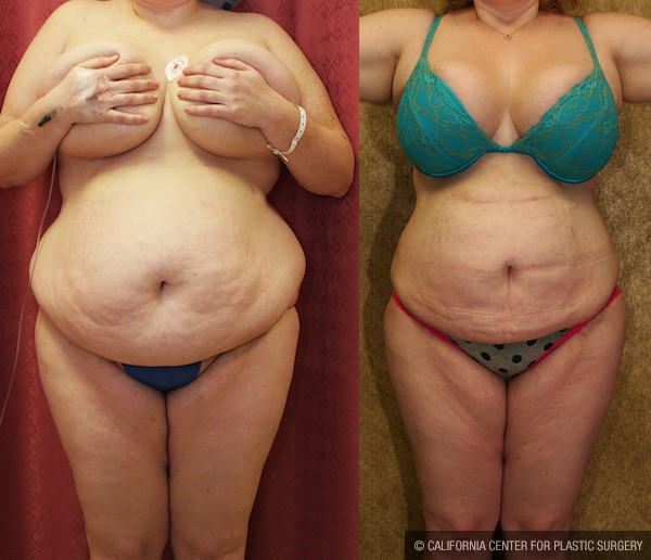 Liposuction Abdomen Plus Size Before & After Patient #12004