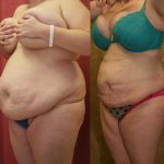 Liposuction Abdomen Plus Size Before & After Patient #12004