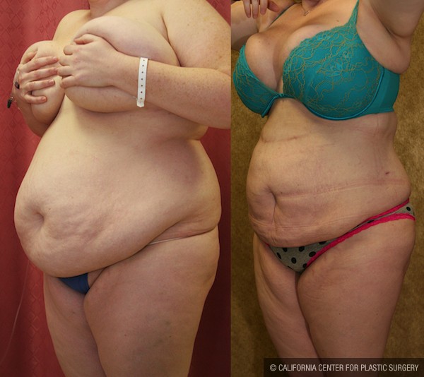 Liposuction Abdomen Plus Size Before & After Patient #12004