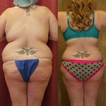 Liposuction Abdomen Plus Size Before & After Patient #12004