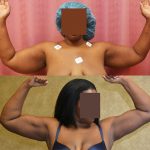 Liposuction Arms Before & After Patient #12020