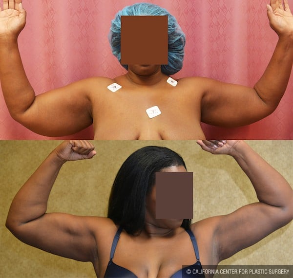Liposuction Arms Before & After Patient #12020