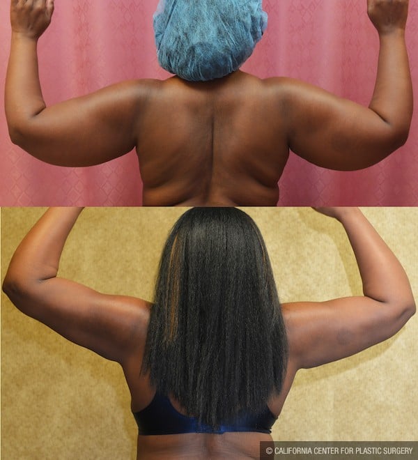 Liposuction Arms Before & After Patient #12020