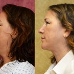 Neck & Face Liposuction Before & After Patient #12023