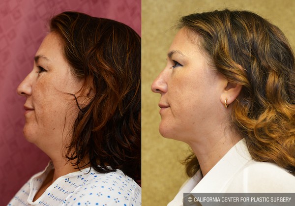 Neck & Face Liposuction Before & After Patient #12023
