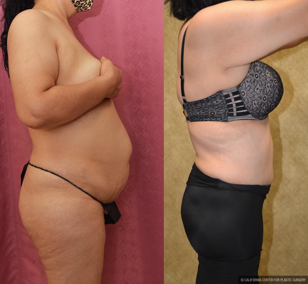 Tummy Tuck (Abdominoplasty) Medium Size Before & After Patient #12194