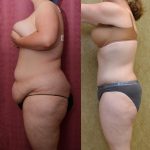 Tummy Tuck (Abdominoplasty) Medium Size Before & After Patient #12198