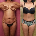 Tummy Tuck (Abdominoplasty) Small Size Before & After Patient #12207