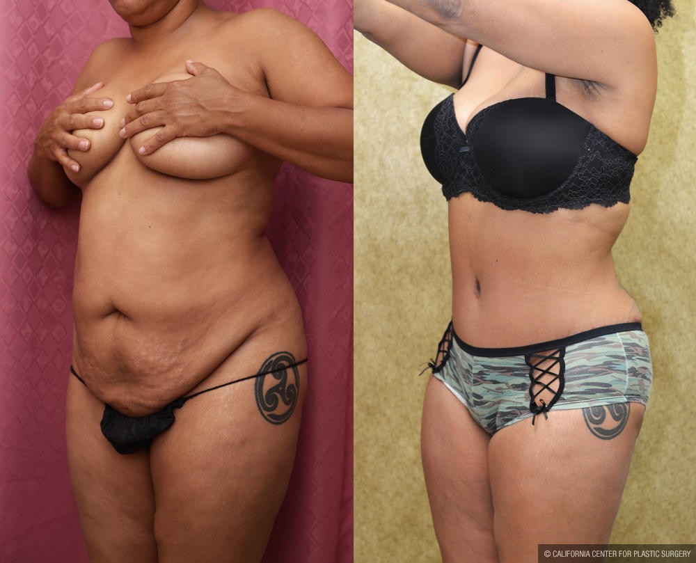 Tummy Tuck (Abdominoplasty) Small Size Before & After Patient #12207