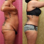 Tummy Tuck (Abdominoplasty) Small Size Before & After Patient #12207