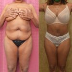 Tummy Tuck (Abdominoplasty) Small Size Before & After Patient #12220