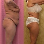 Tummy Tuck (Abdominoplasty) Small Size Before & After Patient #12220