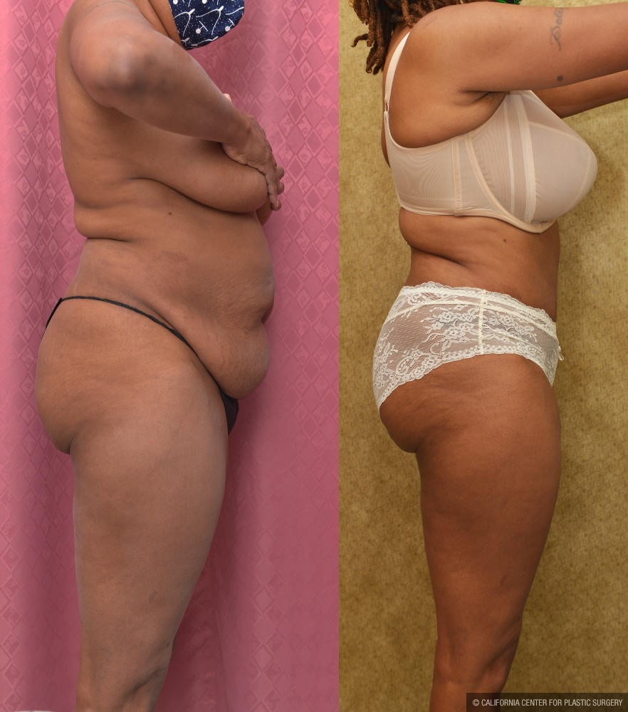 Tummy Tuck (Abdominoplasty) Small Size Before & After Patient #12220