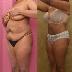 Tummy Tuck (Abdominoplasty) Small Size Before & After Patient #12220