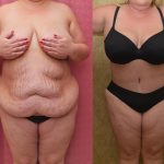 Tummy Tuck (Abdominoplasty) Plus Size Before & After Patient #12202