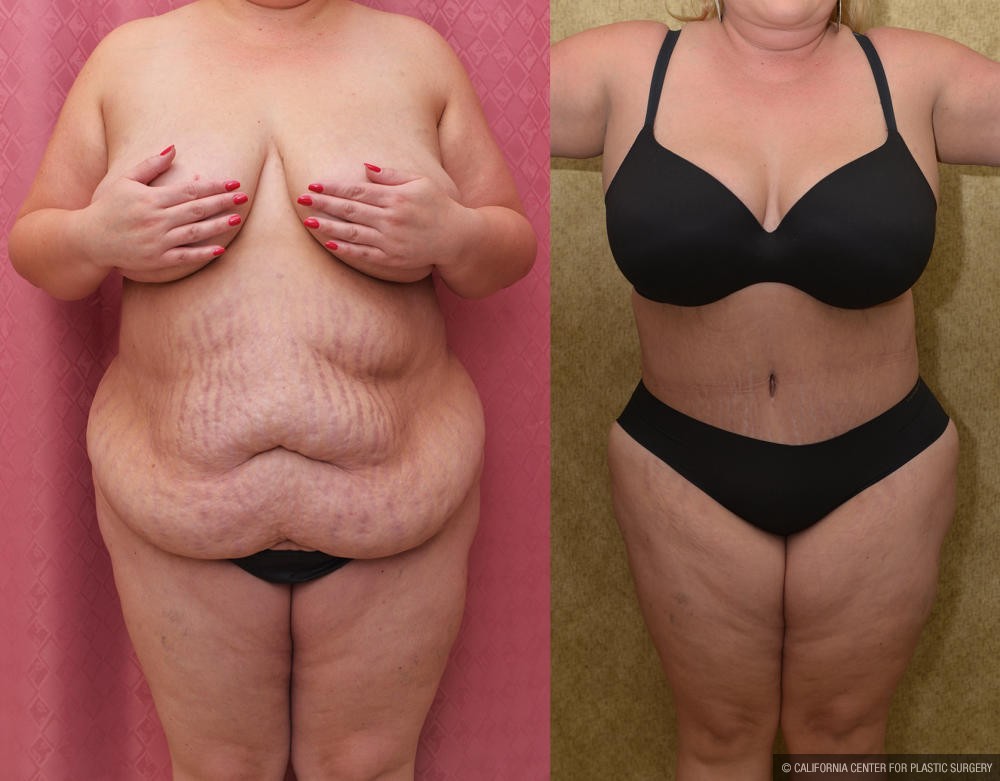 Tummy Tuck (Abdominoplasty) Plus Size Before & After Patient #12202