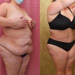 Tummy Tuck (Abdominoplasty) Plus Size Before & After Patient #12202