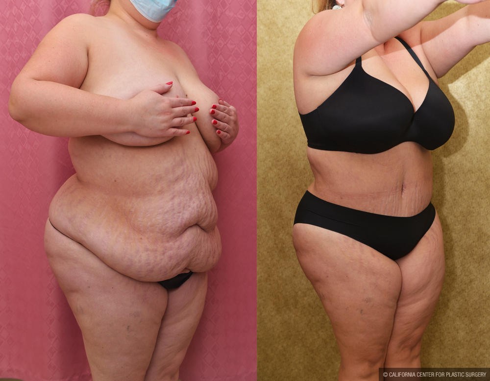 Tummy Tuck (Abdominoplasty) Plus Size Before & After Patient #12202