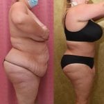 Tummy Tuck (Abdominoplasty) Plus Size Before & After Patient #12202