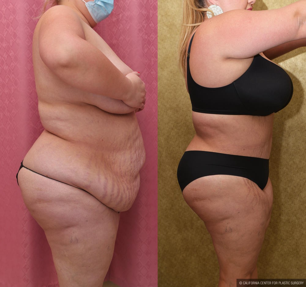 Tummy Tuck (Abdominoplasty) Plus Size Before & After Patient #12202