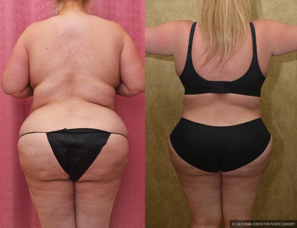 Tummy Tuck (Abdominoplasty) Plus Size Before & After Patient #12202