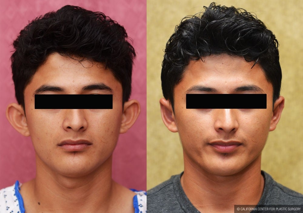 Ear (Otoplasty) Before & After Patient #12162