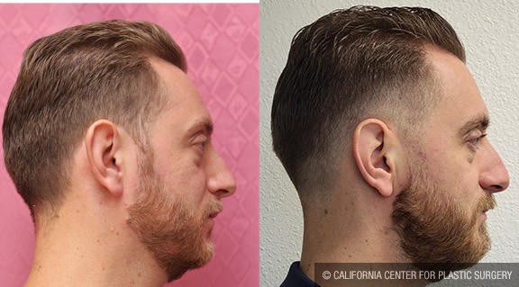 Ear (Otoplasty) Before & After Patient #12170
