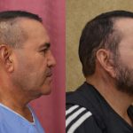 Male Rhinoplasty Before & After Patient #12166