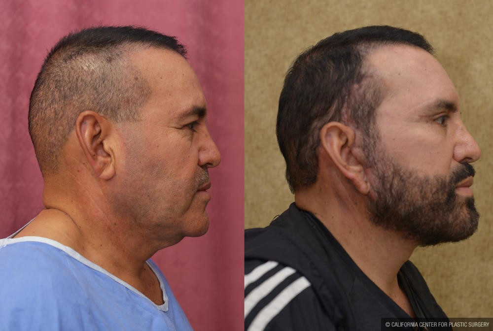 Male Rhinoplasty Before & After Patient #12166