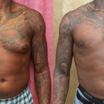 Male gynecomastia (breast) reduction Before & After Patient #12174