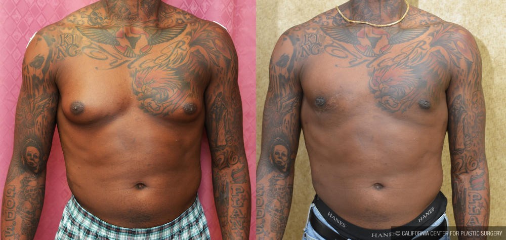 Male gynecomastia (breast) reduction Before & After Patient #12174