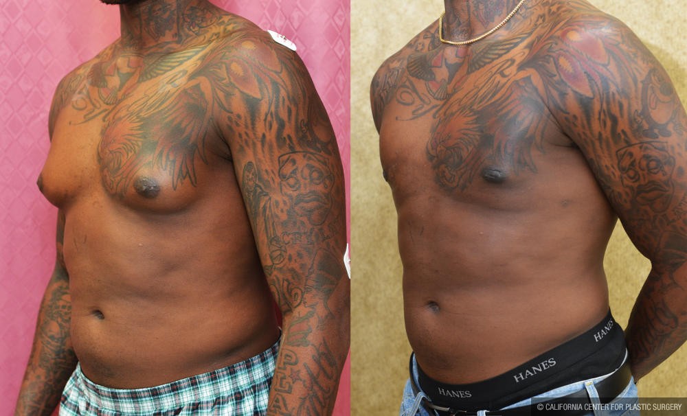 Male gynecomastia (breast) reduction Before & After Patient #12174