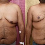 Male gynecomastia (breast) reduction Before & After Patient #12178