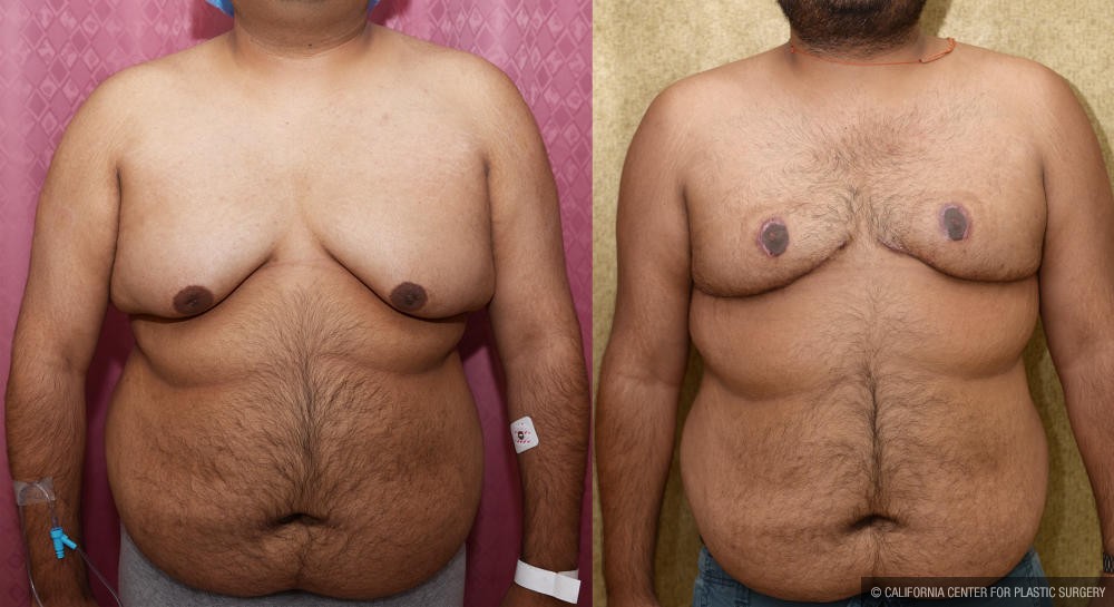 Male gynecomastia (breast) reduction Before & After Patient #12178