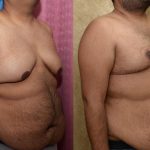 Male gynecomastia (breast) reduction Before & After Patient #12178