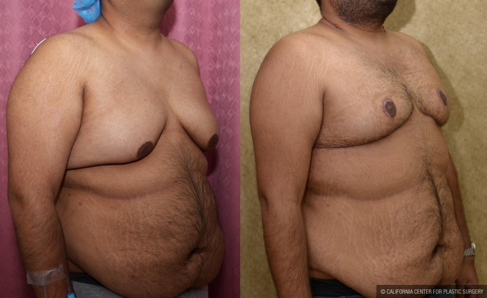 Male gynecomastia (breast) reduction Before & After Patient #12178