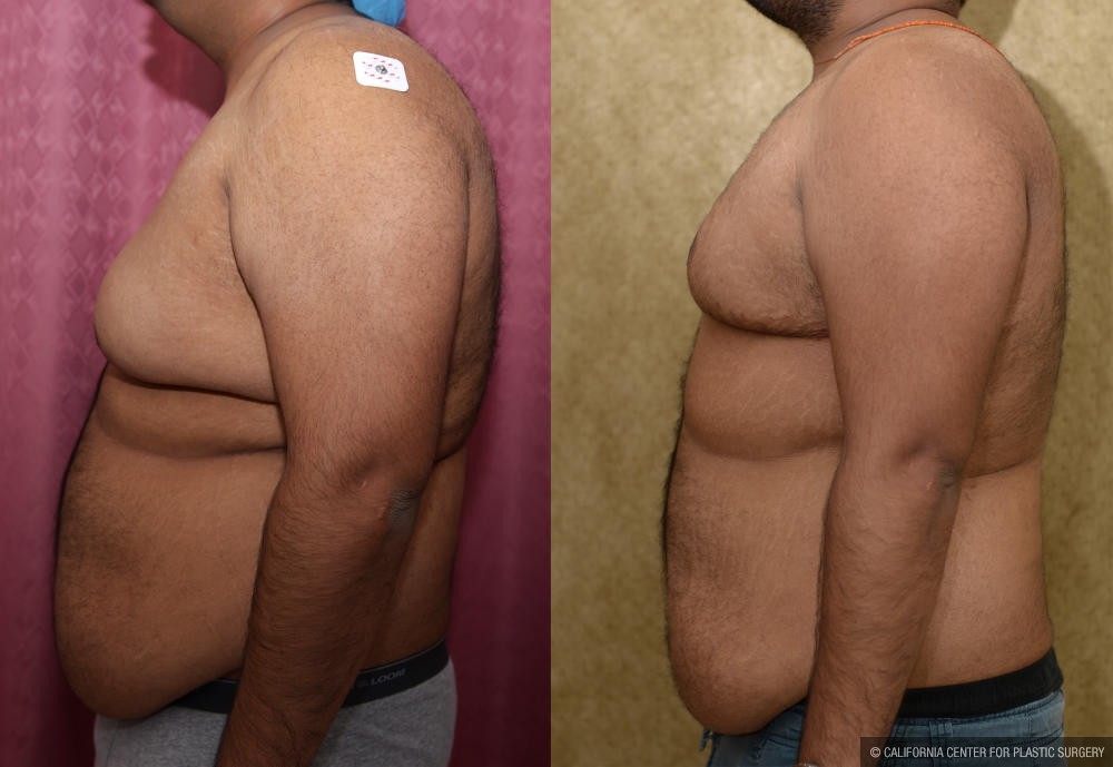 Male gynecomastia (breast) reduction Before & After Patient #12178