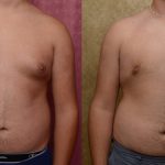 Male gynecomastia (breast) reduction Before & After Patient #12182