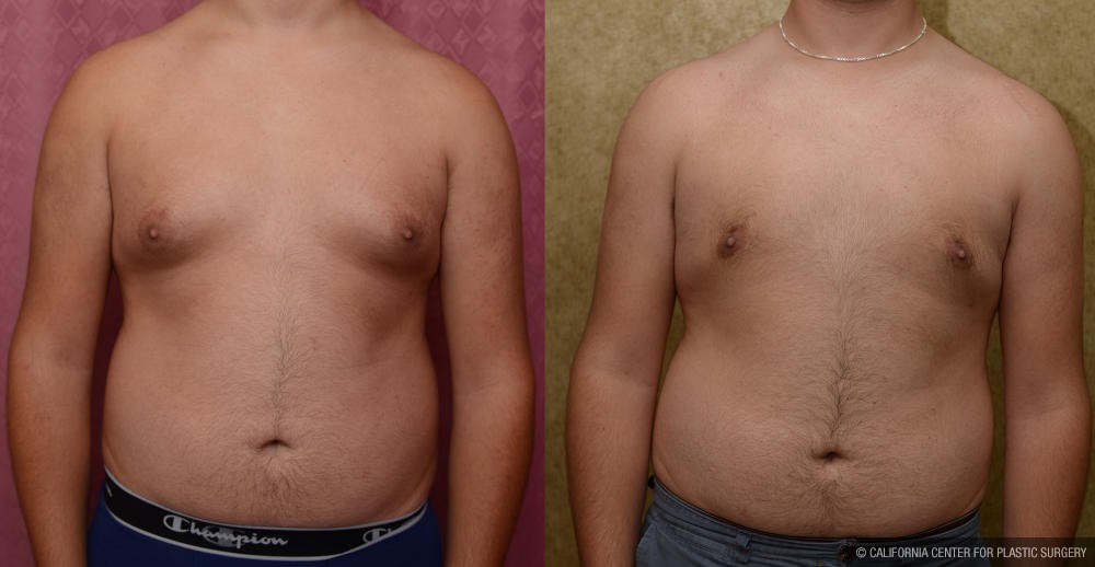 Male gynecomastia (breast) reduction Before & After Patient #12182