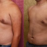 Male gynecomastia (breast) reduction Before & After Patient #12182