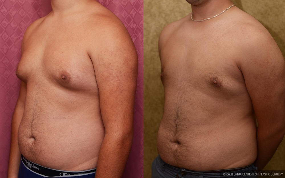 Male gynecomastia (breast) reduction Before & After Patient #12182