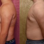 Male gynecomastia (breast) reduction Before & After Patient #12182