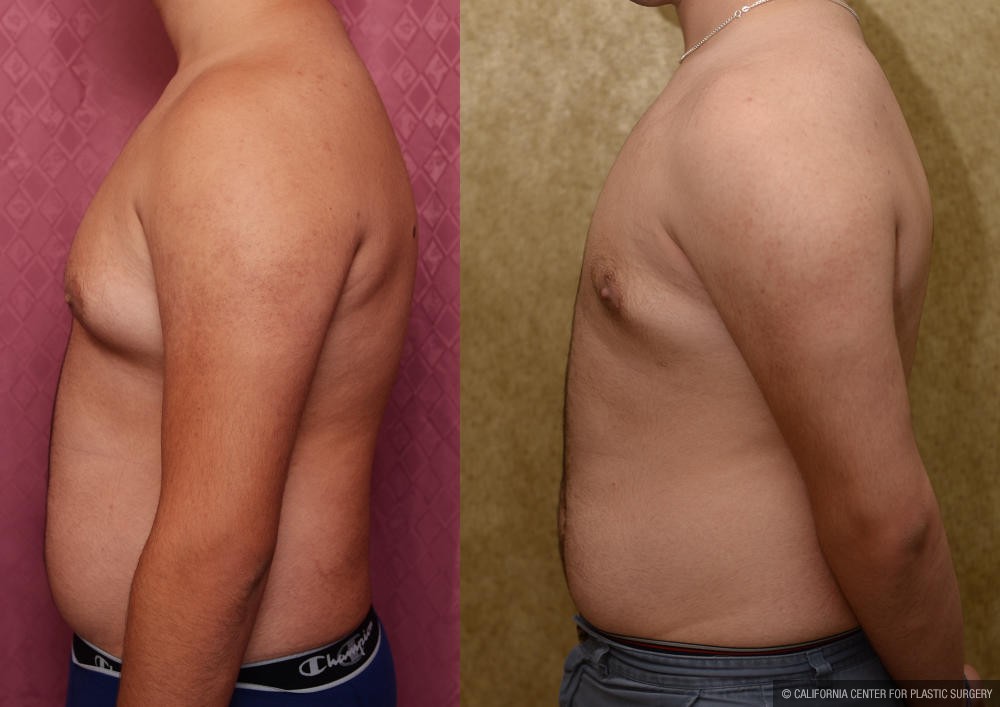Male gynecomastia (breast) reduction Before & After Patient #12182