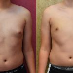 Male gynecomastia (breast) reduction Before & After Patient #12186