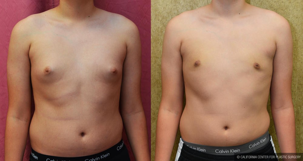 Male gynecomastia (breast) reduction Before & After Patient #12186