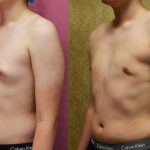 Male gynecomastia (breast) reduction Before & After Patient #12186